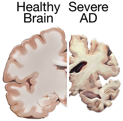 02_healthybrain