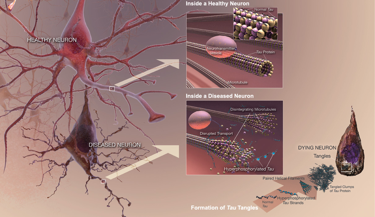Hyperphosphorylation of tau and formation of tangles in disease brain. Image courtesy of National Institute on Aging/NIH