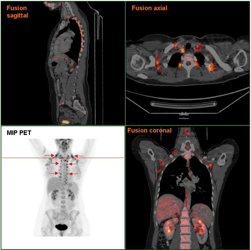 From Wikipedia, PET/ CT scan showing brown fat in a human.