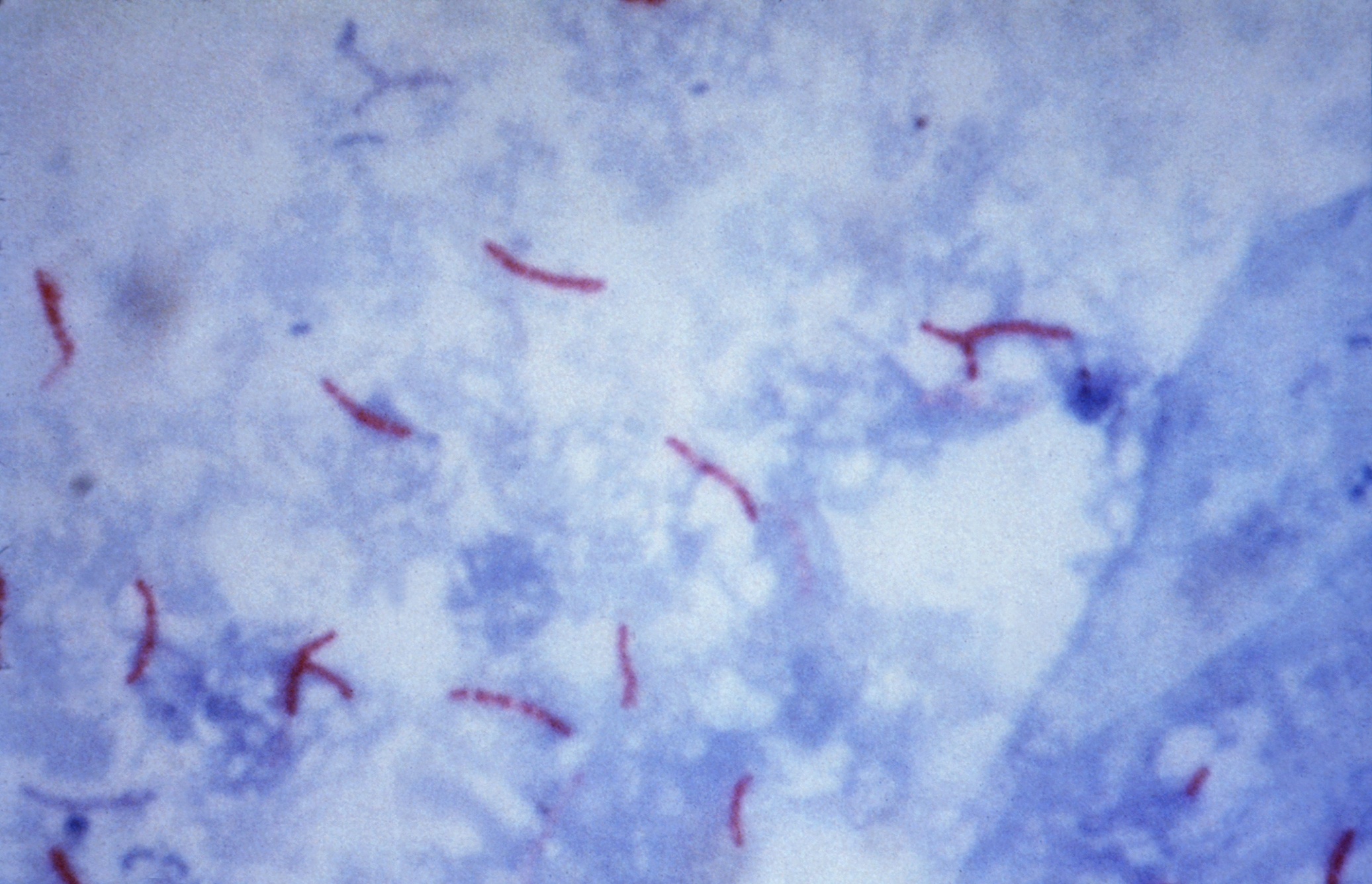 Mycobacterium tuberculosis (Ziehl Neelsen stain). Photo credit: Centers for Disease Control and Prevention.  