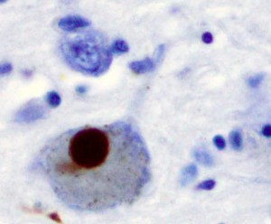 Lewy Body stained with alpha-synuclein.