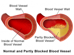 A normal versus a partially blocked artery.