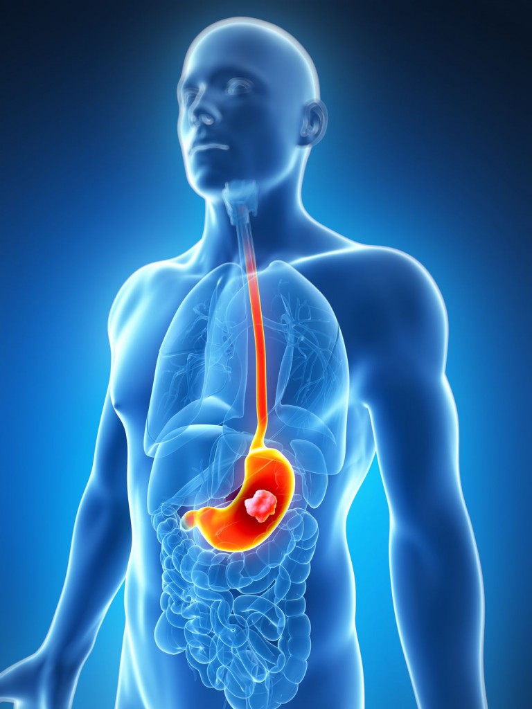 gastric cancer