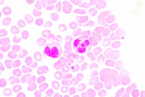 Blood smear showing two prominent neutrophils in the field of view