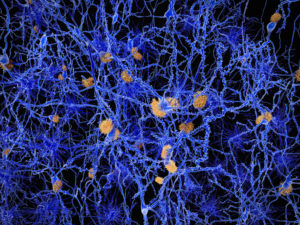 Neurons with amyloid plaques.
