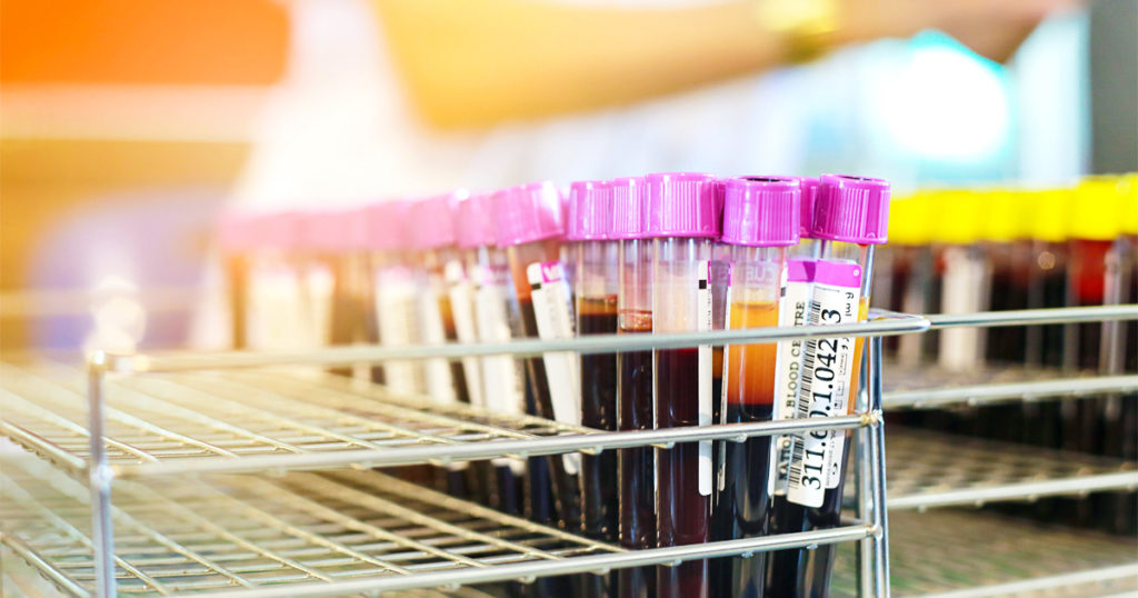 Blood collection tubes in a rack. Researchers are learning more about  Type 2 diabetes