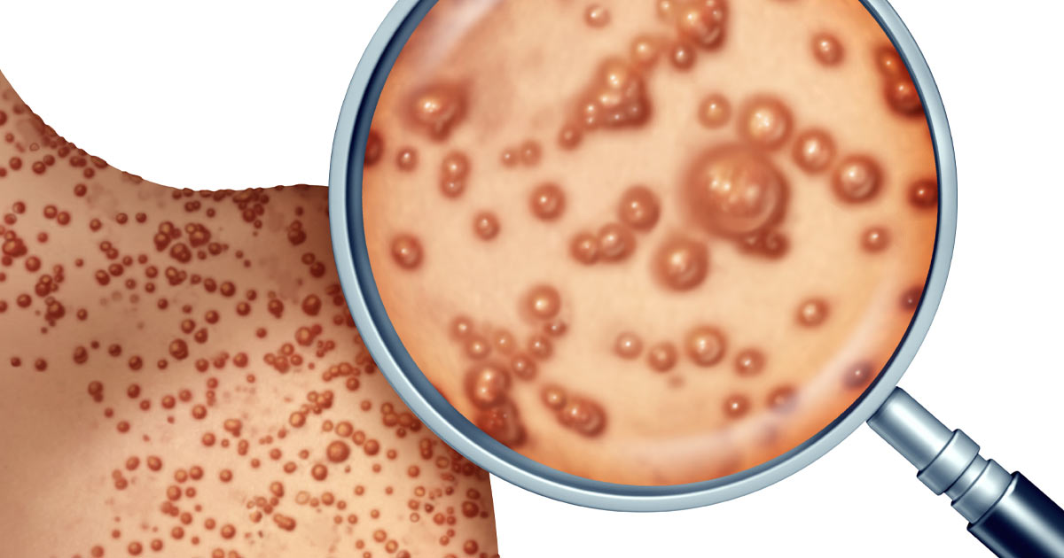 Monkeypox Box Mpox—The Latest Zoonotic Virus Making Headlines - Promega Connections
