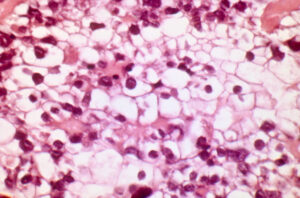 A carcinoma resembling clear cell carcinoma. Source: NIH