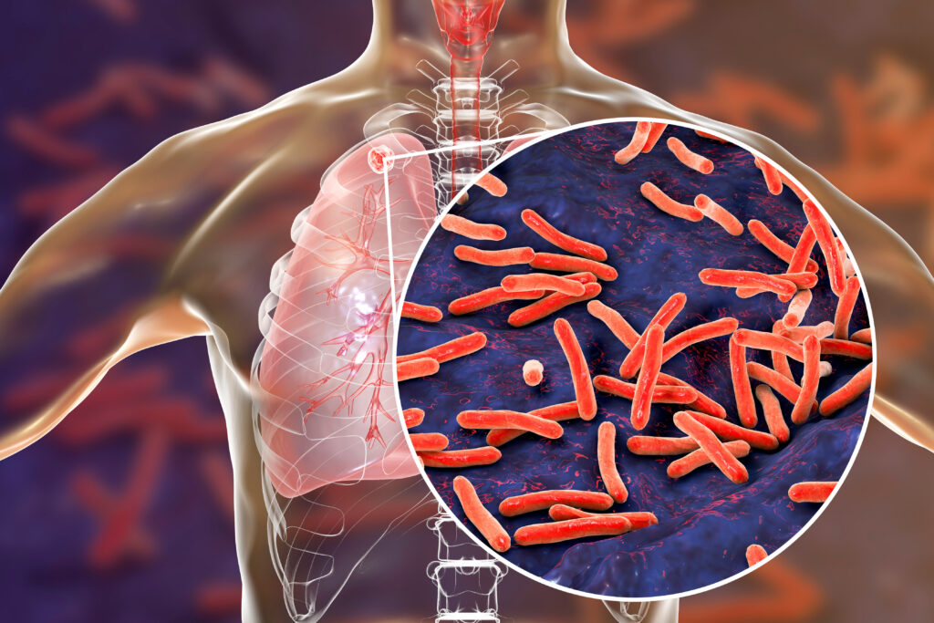 Secondary tuberculosis in lungs and close-up view of Mycobacterium tuberculosis bacteria, 3D illustration